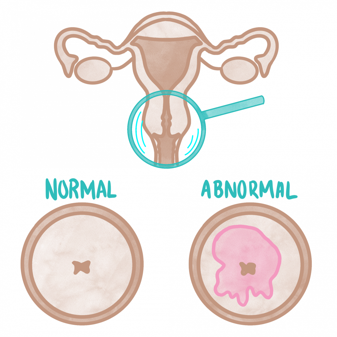 cervical cancer