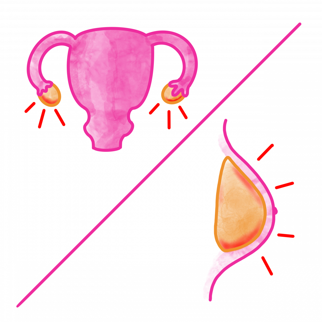 Image shows swelling of ovaries and breast tissue