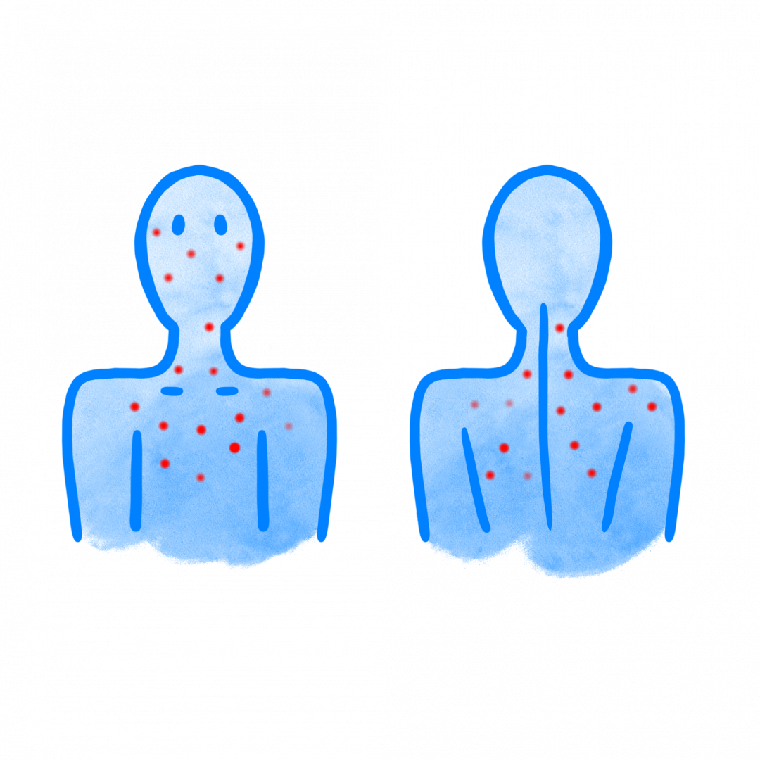 Image depicts regions of body where rash may appear