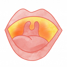 Image depicts open mouth with infected throat area